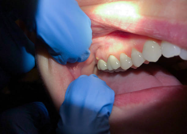 Best Emergency Dental Filling Replacement  in Buchanan, NY